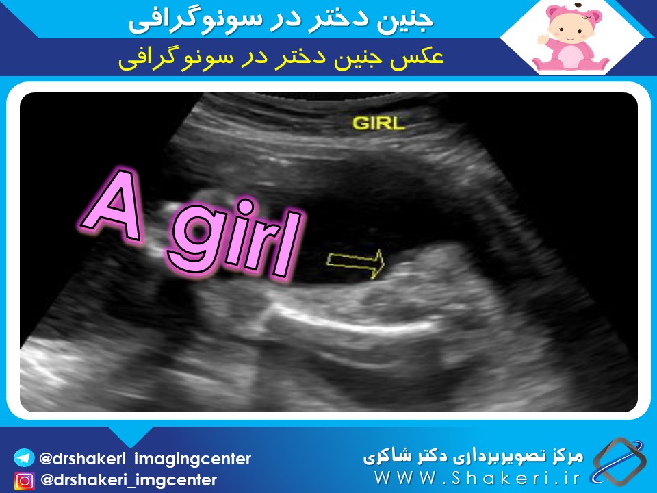 عکس جنین دختر در سونوگرافی