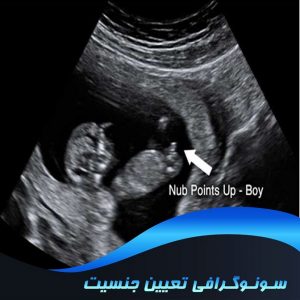 سونوگرافی تعیین جنسیت